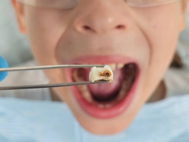 Best Emergency Root Canal Therapy in Cumberland Hill, RI